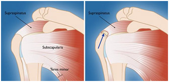 rotator cuff Pathology 